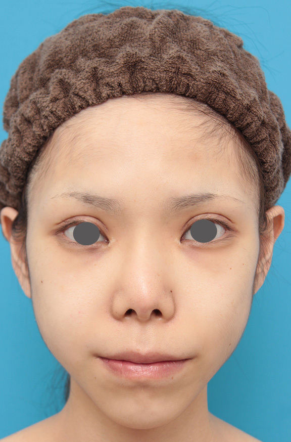 症例写真,上下の厚い唇を手術で程よく薄くした症例写真,After（8ヶ月後）,ba_usuku007_b01.jpg