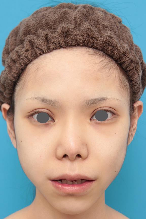 唇を薄く（口唇縮小術）,上下の厚い唇を手術で程よく薄くした症例写真,After（8ヶ月後）,ba_usuku007_b02.jpg