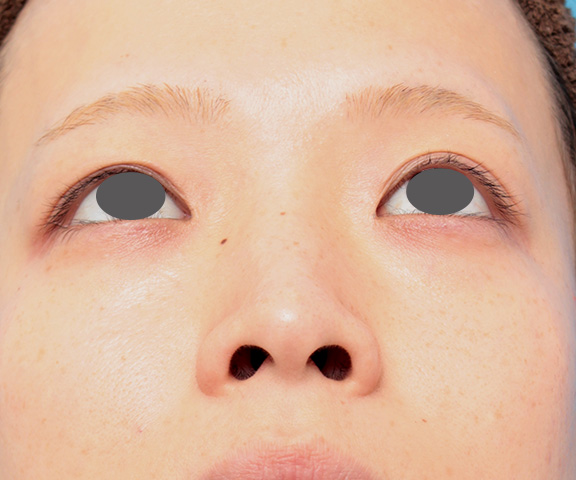 隆鼻術（シリコンプロテーゼ）,鼻プロテーゼと耳介軟骨移植と小鼻縮小を同時に行った症例写真,Before,ba_ryubi1035_b02.jpg