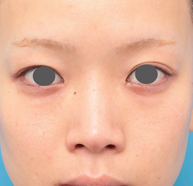 隆鼻術（シリコンプロテーゼ）,鼻プロテーゼと耳介軟骨移植と小鼻縮小を同時に行った症例写真,手術前,mainpic_ryubi1035a.jpg