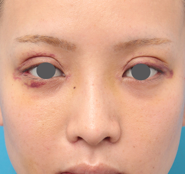 症例写真,鼻プロテーゼと耳介軟骨移植と小鼻縮小を同時に行った症例写真,1週間後,mainpic_ryubi1035c.jpg