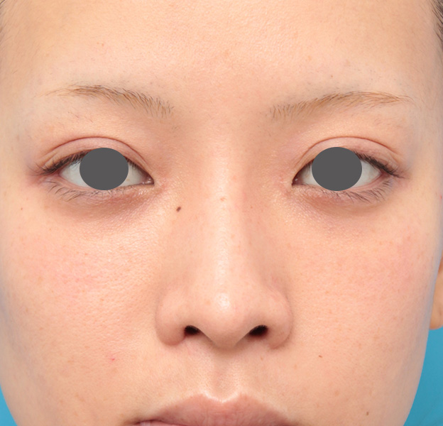 隆鼻術（シリコンプロテーゼ）,鼻プロテーゼと耳介軟骨移植と小鼻縮小を同時に行った症例写真,1ヶ月後,mainpic_ryubi1035d.jpg