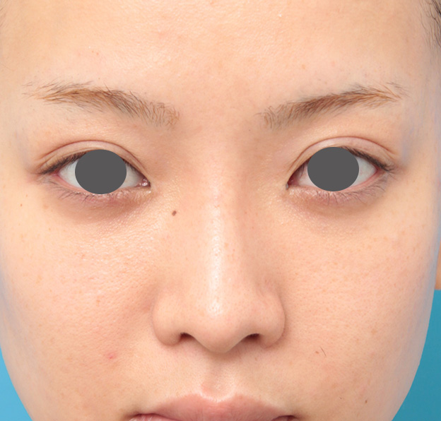 隆鼻術（シリコンプロテーゼ）,鼻プロテーゼと耳介軟骨移植と小鼻縮小を同時に行った症例写真,9ヶ月後,mainpic_ryubi1035e.jpg