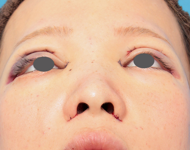 隆鼻術（シリコンプロテーゼ）,鼻プロテーゼと耳介軟骨移植と小鼻縮小を同時に行った症例写真,手術直後,mainpic_ryubi1035g.jpg