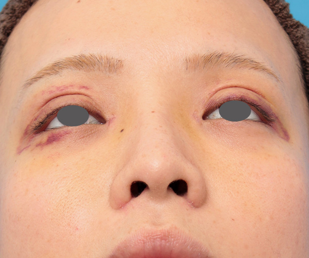 隆鼻術（シリコンプロテーゼ）,鼻プロテーゼと耳介軟骨移植と小鼻縮小を同時に行った症例写真,1週間後,mainpic_ryubi1035h.jpg