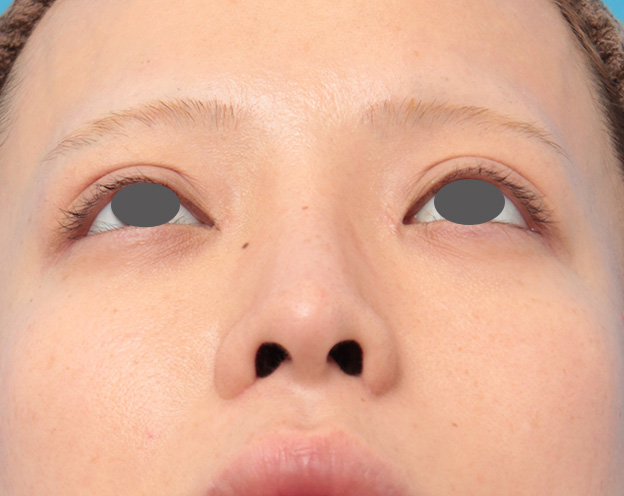 隆鼻術（シリコンプロテーゼ）,鼻プロテーゼと耳介軟骨移植と小鼻縮小を同時に行った症例写真,1ヶ月後,mainpic_ryubi1035i.jpg