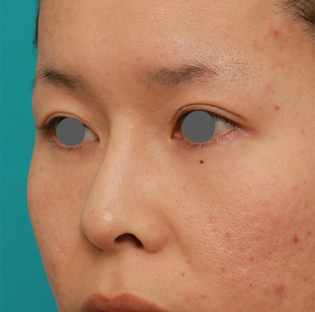 隆鼻術（シリコンプロテーゼ）,他院で入れた曲がっているL型鼻シリコンプロテーゼをI型に入れ替え、耳介軟骨移植もした症例写真,6ヶ月後,mainpic_ryubi1036h.jpg