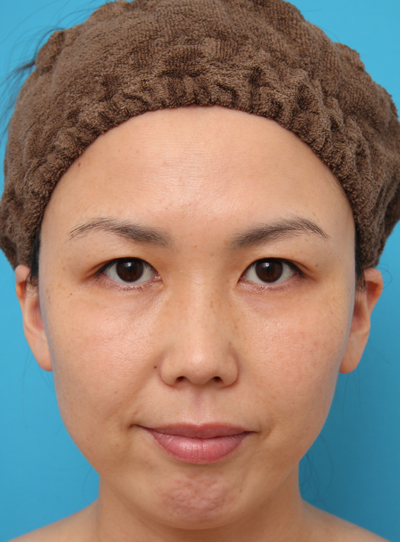 二重まぶた・埋没法,二重まぶた埋没法2針固定でたるんでいる皮膚を持ち上げて目を大きくした30代女性の症例写真,After（6ヶ月後）,ba_maibotsu036_b01.jpg