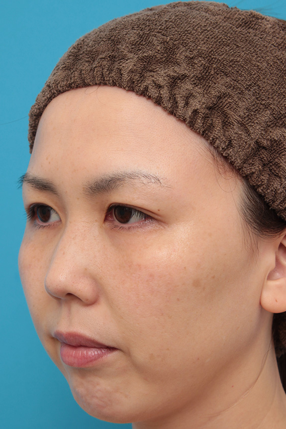 症例写真,二重まぶた埋没法2針固定でたるんでいる皮膚を持ち上げて目を大きくした30代女性の症例写真,After（6ヶ月後）,ba_maibotsu036_b02.jpg