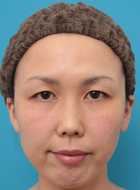 二重まぶた埋没法2針固定でたるんでいる皮膚を持ち上げて目を大きくした30代女性の症例写真,Before,ba_maibotsu036_b01.jpg
