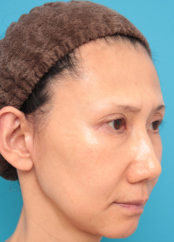 こめかみリフト,こめかみリフトで顔の上半分の外側のたるみをリフトアップした症例写真,After（6ヶ月後）,ba_komekamilift002_b02.jpg