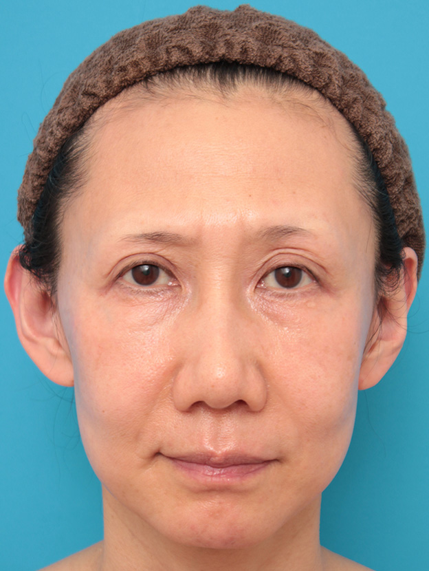 こめかみリフト,こめかみリフトで顔の上半分の外側のたるみをリフトアップした症例写真,手術前,mainpic_komekamilift002a.jpg