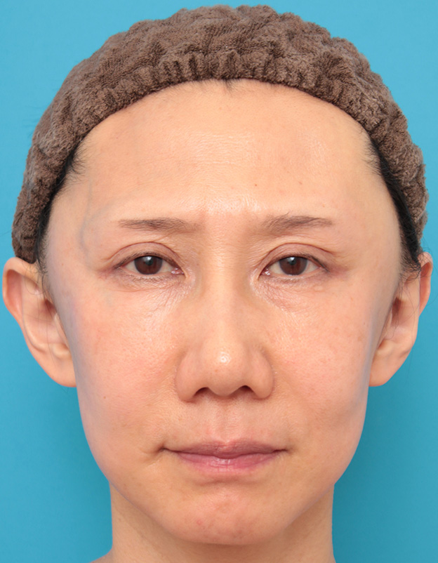 こめかみリフト,こめかみリフトで顔の上半分の外側のたるみをリフトアップした症例写真,手術直後,mainpic_komekamilift002b.jpg