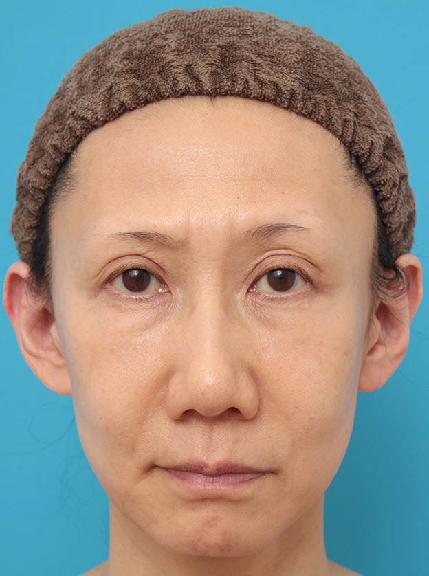 こめかみリフト,こめかみリフトで顔の上半分の外側のたるみをリフトアップした症例写真,1週間後,mainpic_komekamilift002c.jpg