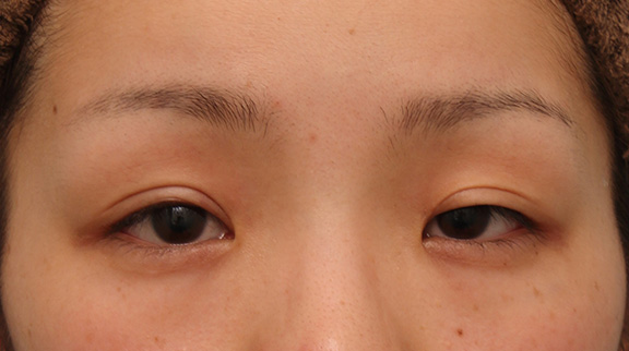 目頭切開,他院で二重まぶた切開法を受けた後、眼瞼下垂手術に準じて修正し、同時に目頭切開も行った症例,Before,ba_sekkai047_b01.jpg