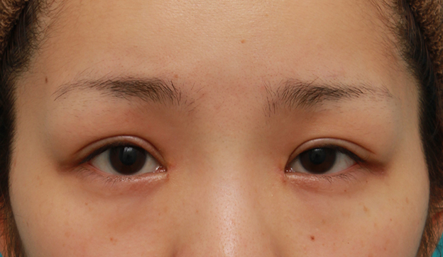 目頭切開,他院で二重まぶた切開法を受けた後、眼瞼下垂手術に準じて修正し、同時に目頭切開も行った症例,3週間後,mainpic_sekkai047d.jpg