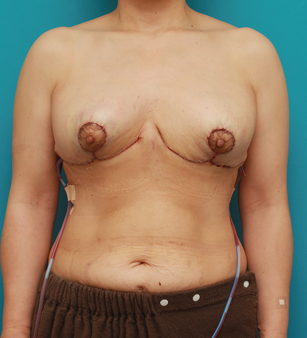 乳房縮小手術（マンマリダクション）,乳房縮小手術（マンマリダクション）で、大きくて垂れているバストを吊り上げて小さくした症例写真,手術直後,mainpic_shukusho003b.jpg