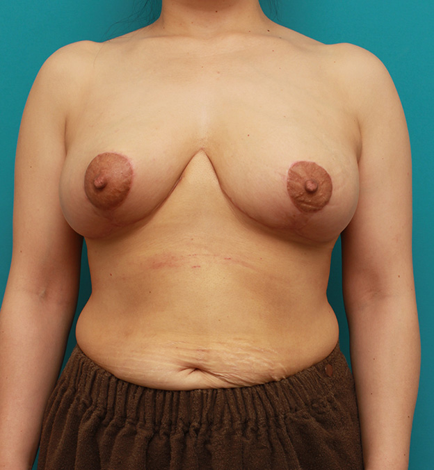 乳房縮小手術（マンマリダクション）,乳房縮小手術（マンマリダクション）で、大きくて垂れているバストを吊り上げて小さくした症例写真,1ヶ月後,mainpic_shukusho003e.jpg