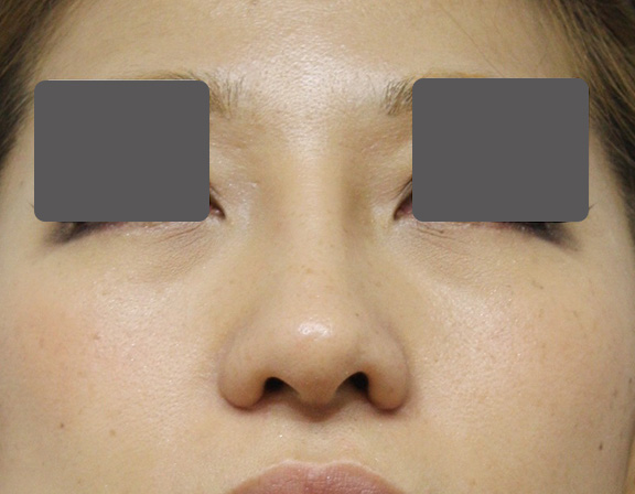 隆鼻術（シリコンプロテーゼ）,5mmの鼻シリコンプロテーゼ+小鼻（鼻翼）縮小手術を行った20代女性の症例写真,After（6ヶ月後）,ba_ryubi1037_b02.jpg