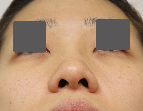 鼻翼縮小（小鼻縮小）,5mmの鼻シリコンプロテーゼ+小鼻（鼻翼）縮小手術を行った20代女性の症例写真,Before,ba_ryubi1037_b02.jpg