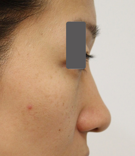 隆鼻術（シリコンプロテーゼ）,5mmの鼻シリコンプロテーゼ+小鼻（鼻翼）縮小手術を行った20代女性の症例写真,Before,ba_ryubi1037_b03.jpg