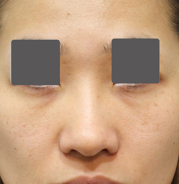 鼻翼縮小（小鼻縮小）,5mmの鼻シリコンプロテーゼ+小鼻（鼻翼）縮小手術を行った20代女性の症例写真,手術前,mainpic_ryubi1037a.jpg