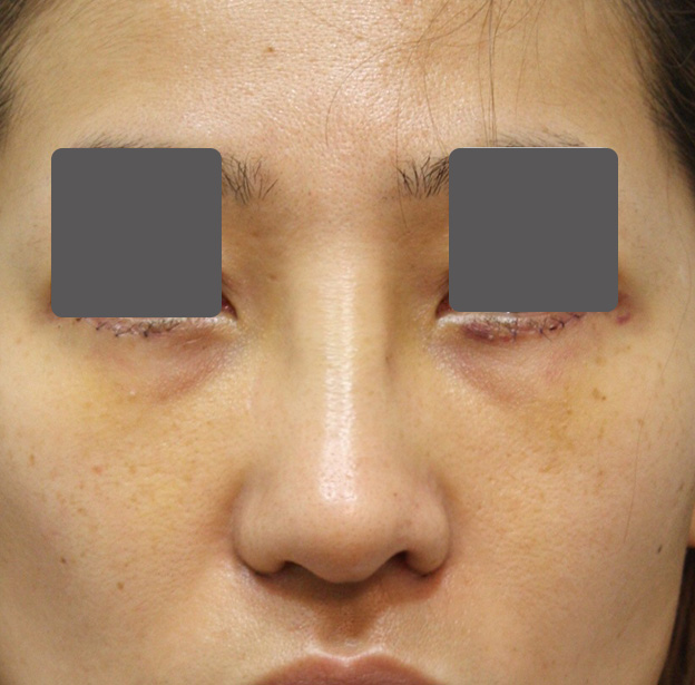 隆鼻術（シリコンプロテーゼ）,5mmの鼻シリコンプロテーゼ+小鼻（鼻翼）縮小手術を行った20代女性の症例写真,手術直後,mainpic_ryubi1037b.jpg