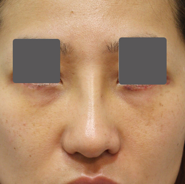 隆鼻術（シリコンプロテーゼ）,5mmの鼻シリコンプロテーゼ+小鼻（鼻翼）縮小手術を行った20代女性の症例写真,1週間後,mainpic_ryubi1037c.jpg