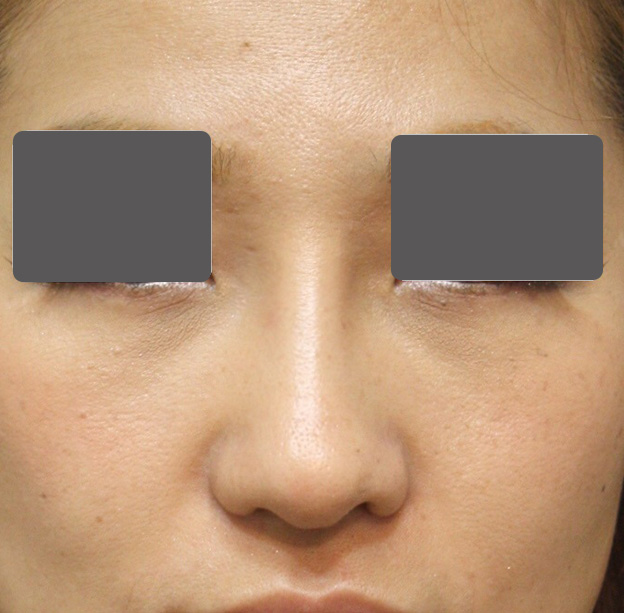 鼻翼縮小（小鼻縮小）,5mmの鼻シリコンプロテーゼ+小鼻（鼻翼）縮小手術を行った20代女性の症例写真,6ヶ月後,mainpic_ryubi1037d.jpg