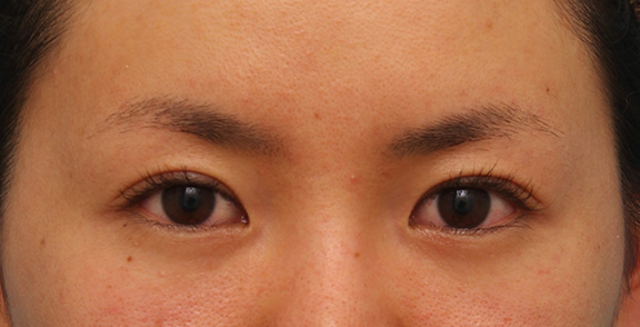 垂れ目（パンダ目）形成（グラマラスライン／下眼瞼下制術）,目尻切開とタレ目形成（グラマラスライン）を同時に行った20代女性の症例写真,Before,ba_mejiri013_b01.jpg