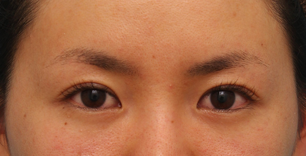 垂れ目（パンダ目）形成（グラマラスライン／下眼瞼下制術）,目尻切開とタレ目形成（グラマラスライン）を同時に行った20代女性の症例写真,手術前,mainpic_mejiri013a.jpg