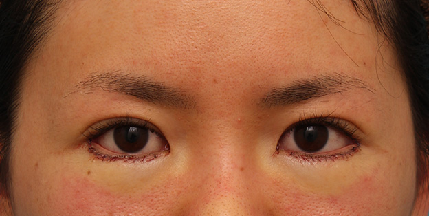 垂れ目（パンダ目）形成（グラマラスライン／下眼瞼下制術）,目尻切開とタレ目形成（グラマラスライン）を同時に行った20代女性の症例写真,手術直後,mainpic_mejiri013b.jpg