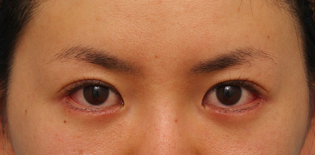 垂れ目（パンダ目）形成（グラマラスライン／下眼瞼下制術）,目尻切開とタレ目形成（グラマラスライン）を同時に行った20代女性の症例写真,1週間後,mainpic_mejiri013c.jpg