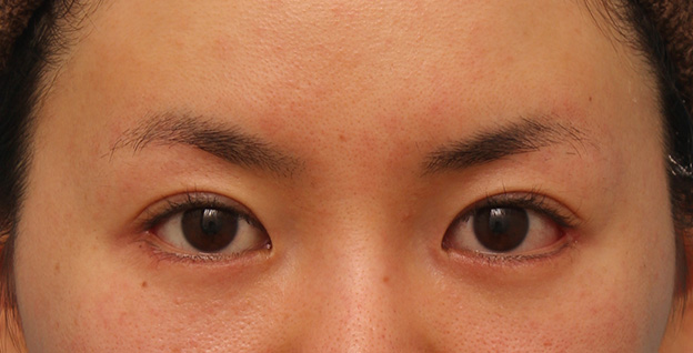 垂れ目（パンダ目）形成（グラマラスライン／下眼瞼下制術）,目尻切開とタレ目形成（グラマラスライン）を同時に行った20代女性の症例写真,3週間後,mainpic_mejiri013d.jpg