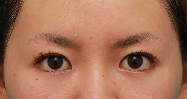 垂れ目（パンダ目）形成（グラマラスライン／下眼瞼下制術）,目尻切開とタレ目形成（グラマラスライン）を同時に行った20代女性の症例写真,6ヶ月後,mainpic_mejiri013f.jpg