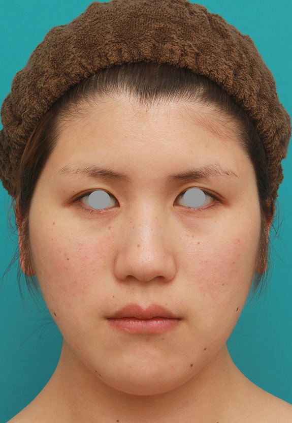 脂肪吸引（頬、あご）,頬、フェイスライン、二重顎の脂肪吸引をして小顔になった症例写真,After（6ヶ月後）,ba_shibo003_b01.jpg