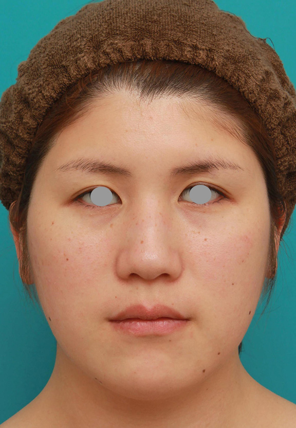 脂肪吸引,頬、フェイスライン、二重顎の脂肪吸引をして小顔になった症例写真,Before,ba_shibo003_b01.jpg