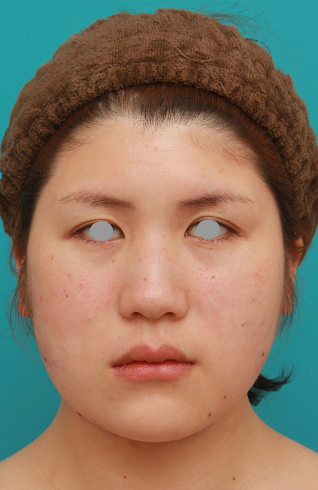 脂肪吸引,頬、フェイスライン、二重顎の脂肪吸引をして小顔になった症例写真,手術直後,mainpic_shibo003b.jpg