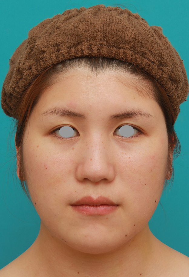 症例写真,頬、フェイスライン、二重顎の脂肪吸引をして小顔になった症例写真,6日後,mainpic_shibo003c.jpg