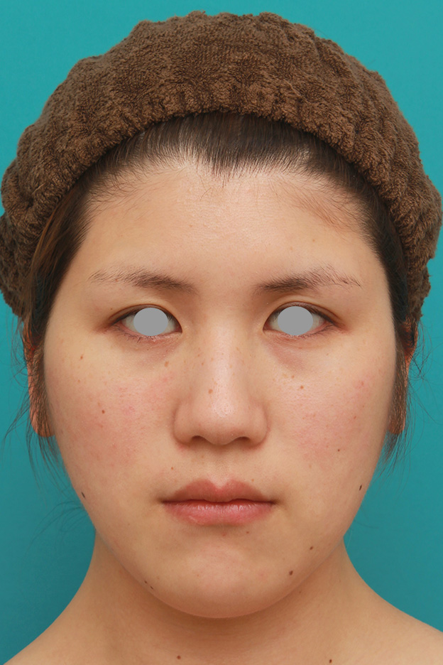 脂肪吸引（頬、あご）,頬、フェイスライン、二重顎の脂肪吸引をして小顔になった症例写真,6ヶ月後,mainpic_shibo003e.jpg