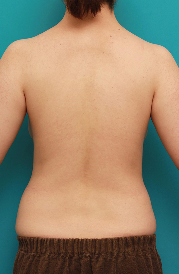 脂肪吸引,二の腕とお腹回りの脂肪吸引を同時に行った症例写真,Before,ba_shibokyuin027_b04.jpg