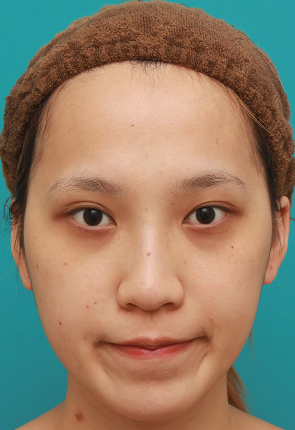隆鼻術（シリコンプロテーゼ）,鼻に3.5mmの高さのシリコンプロテーゼを入れて、自然に鼻筋を通した症例写真,After（6ヶ月後）,ba_ryubi1038_b01.jpg
