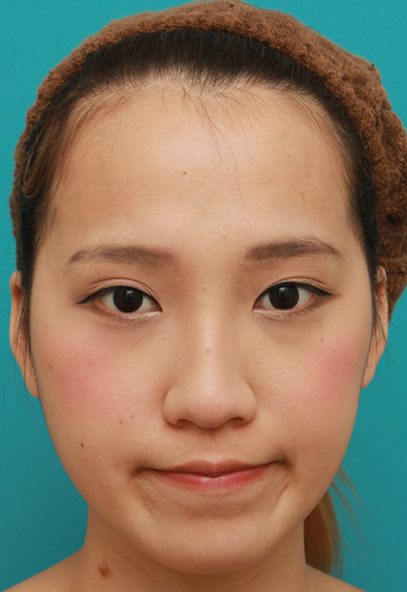 隆鼻術（シリコンプロテーゼ）,鼻に3.5mmの高さのシリコンプロテーゼを入れて、自然に鼻筋を通した症例写真,After（6ヶ月後メイクあり）,