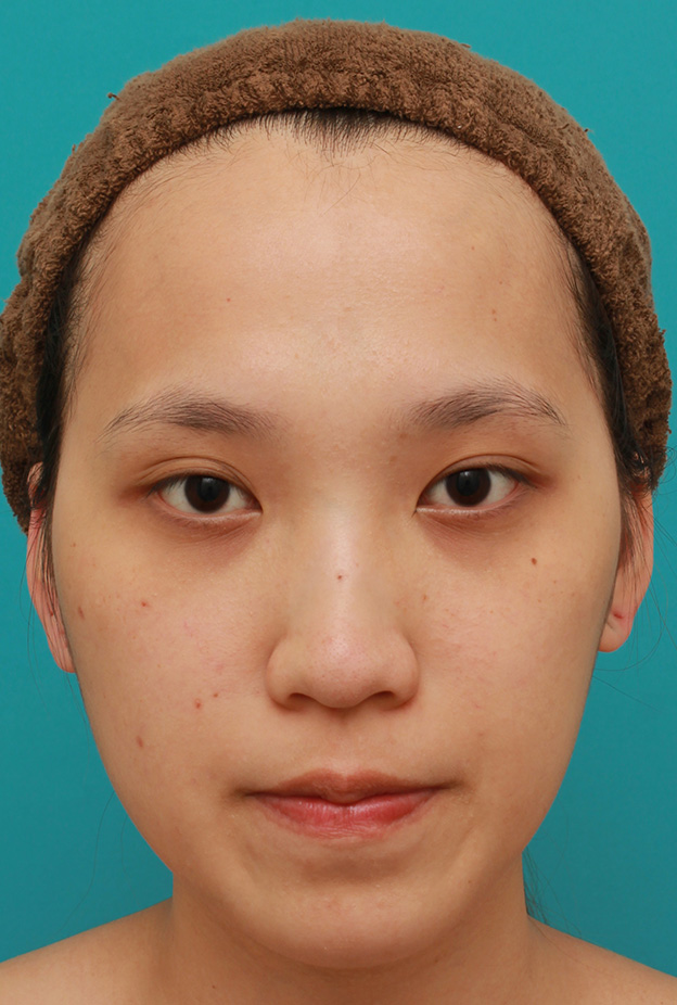 隆鼻術（シリコンプロテーゼ）,鼻に3.5mmの高さのシリコンプロテーゼを入れて、自然に鼻筋を通した症例写真,手術前,mainpic_ryubi1038a.jpg