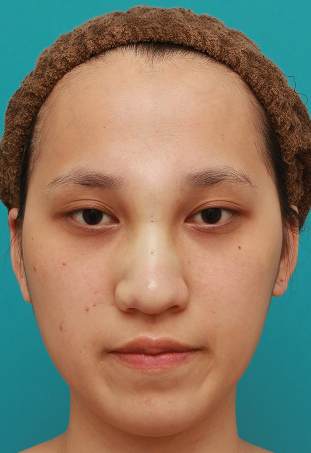 隆鼻術（シリコンプロテーゼ）,鼻に3.5mmの高さのシリコンプロテーゼを入れて、自然に鼻筋を通した症例写真,手術直後,mainpic_ryubi1038b.jpg