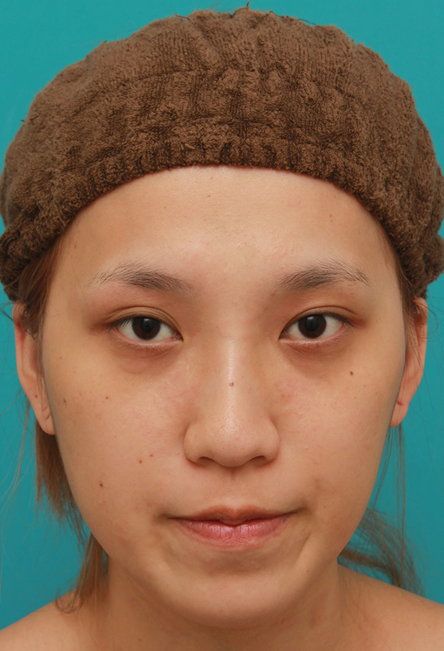 隆鼻術（シリコンプロテーゼ）,鼻に3.5mmの高さのシリコンプロテーゼを入れて、自然に鼻筋を通した症例写真,3週間後,mainpic_ryubi1038d.jpg