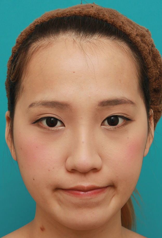 隆鼻術（シリコンプロテーゼ）,鼻に3.5mmの高さのシリコンプロテーゼを入れて、自然に鼻筋を通した症例写真,6ヶ月後,メイクあり,mainpic_ryubi1038f.jpg
