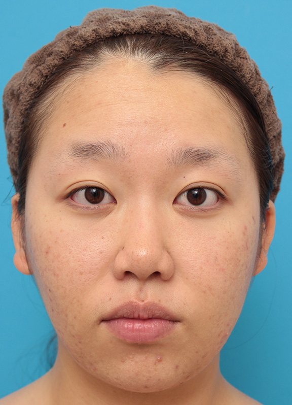 鼻翼縮小（小鼻縮小）,小鼻（鼻翼）縮小手術で鼻の穴の内側から外側の途中にかけて切除した症例写真,After（8ヶ月後）,ba_biyoku039_a01.jpg