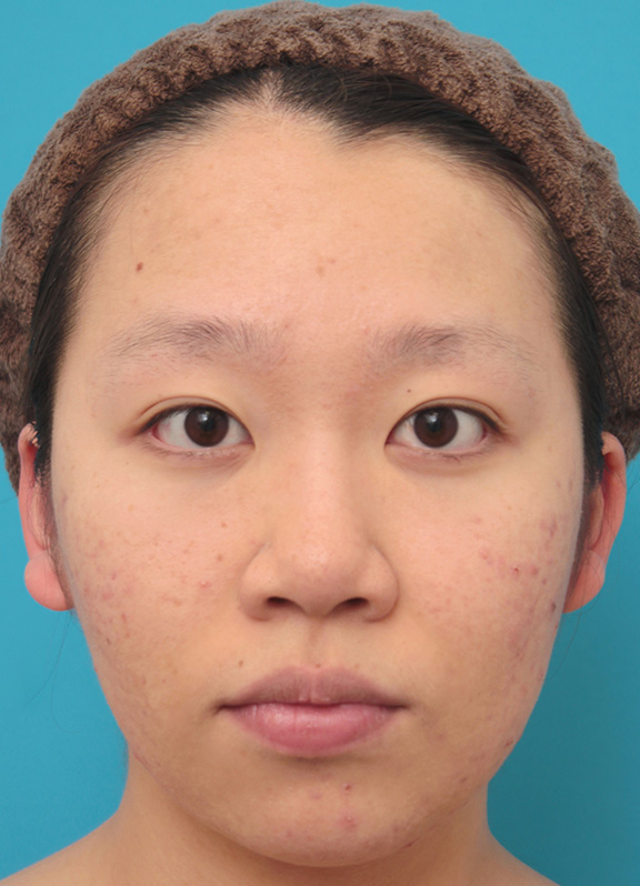 鼻翼縮小（小鼻縮小）,小鼻（鼻翼）縮小手術で鼻の穴の内側から外側の途中にかけて切除した症例写真,Before,ba_biyoku039_b01.jpg