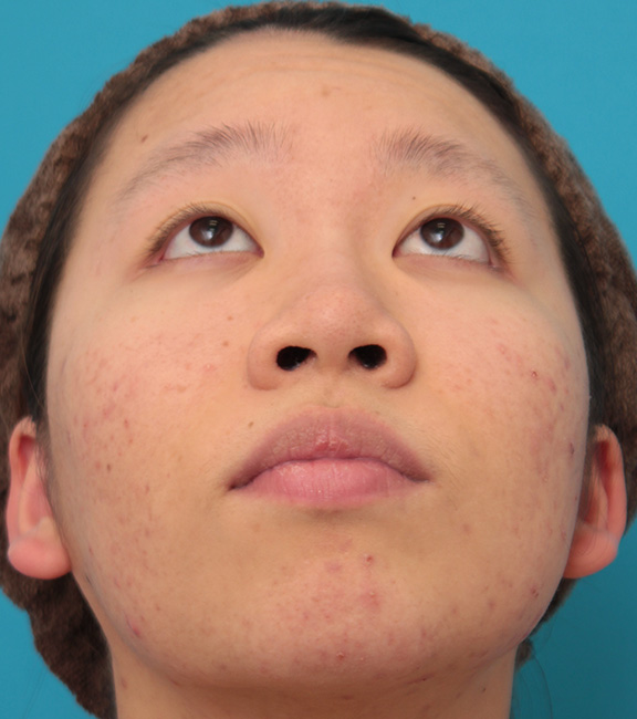 症例写真,小鼻（鼻翼）縮小手術で鼻の穴の内側から外側の途中にかけて切除した症例写真,Before,ba_biyoku039_b02.jpg